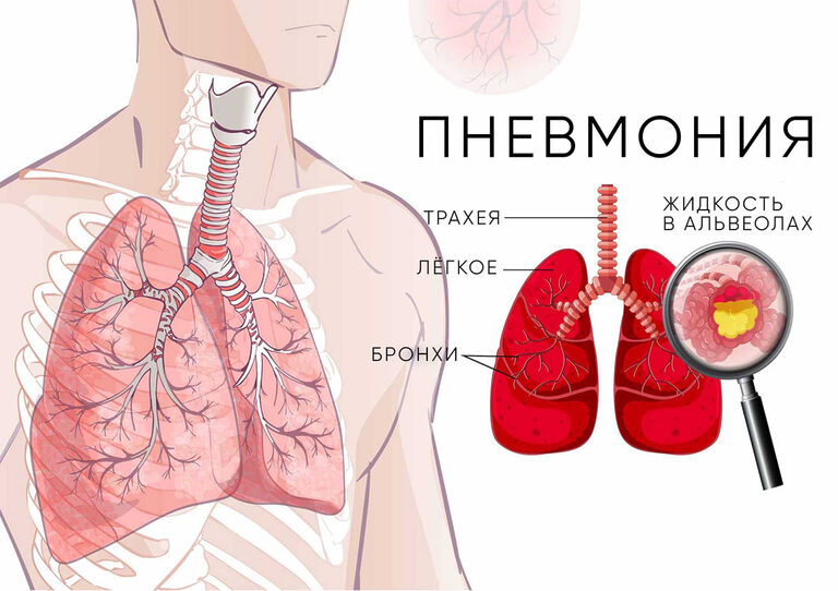 Микоплазменная пневмония в России