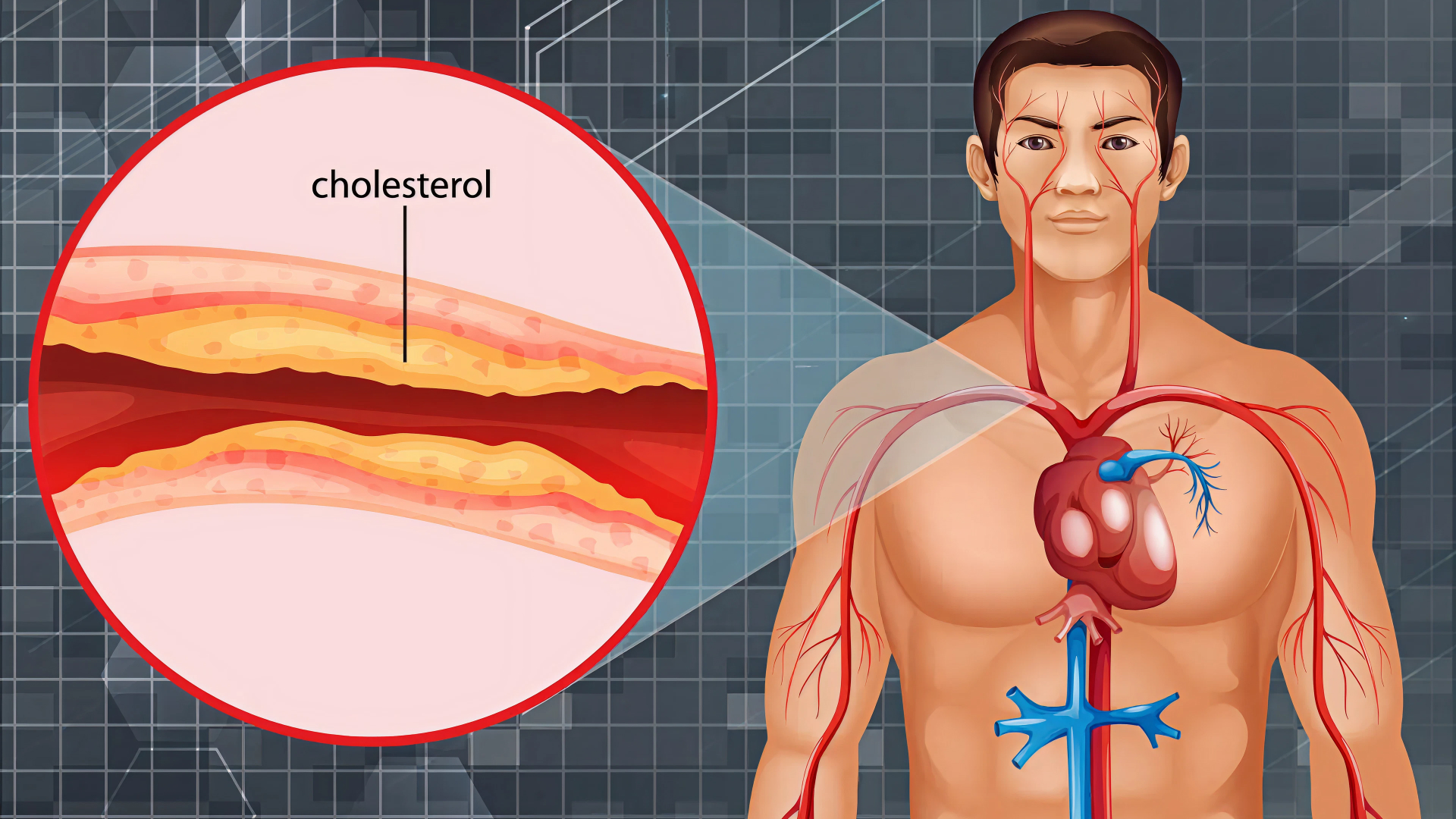 Холестерин и слабоумие