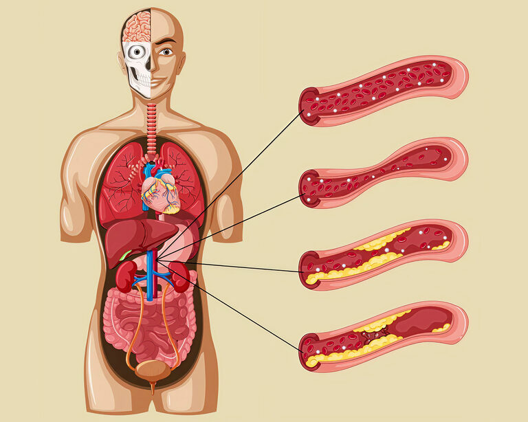Холестерин и слабоумие