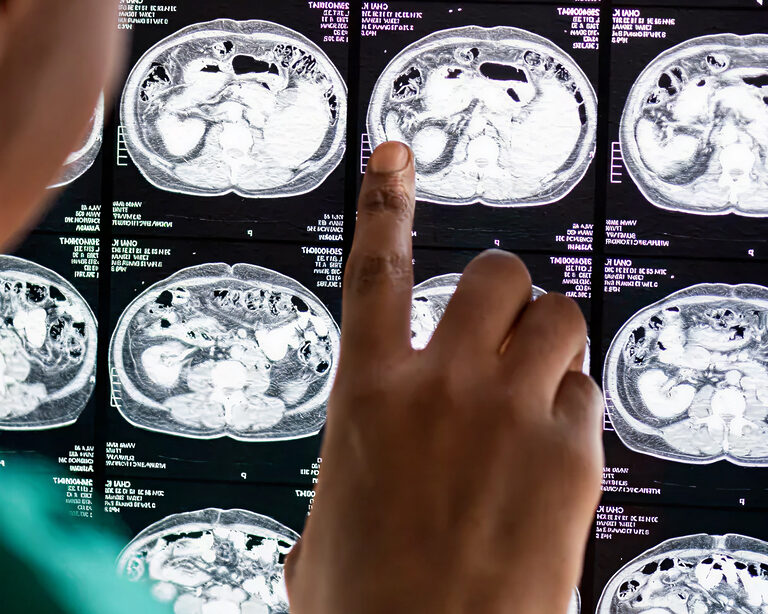 Ключ к прогнозированию агрессивности опухолей