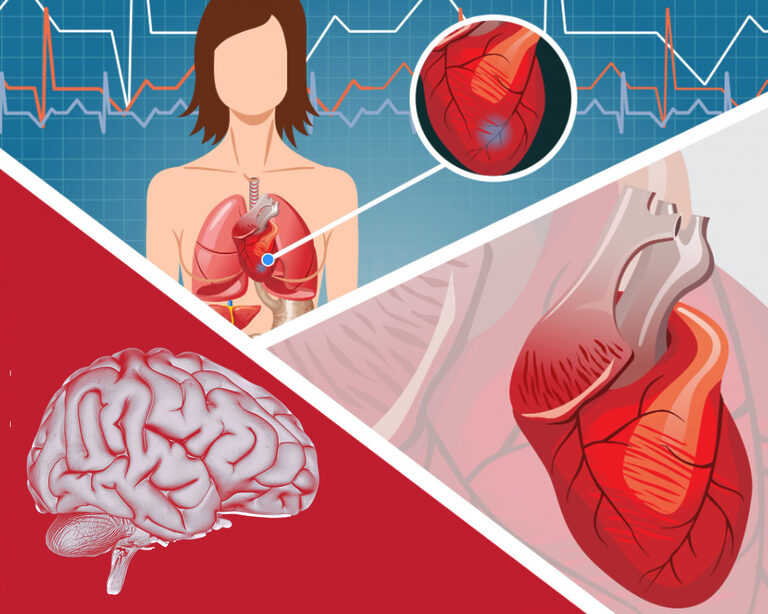 Эффективный удар по инфаркту и инсульту