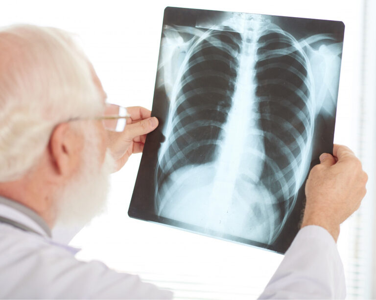 Иммунные клетки и легочный фиброз