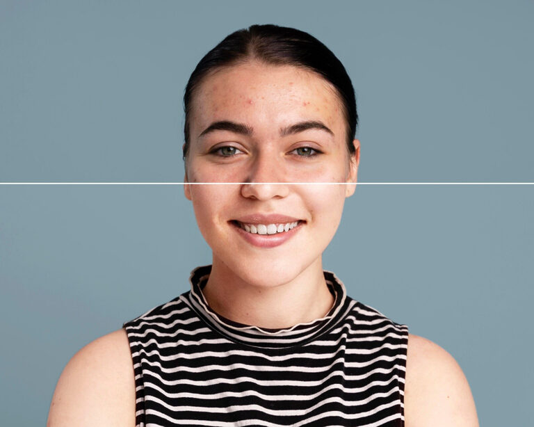 Гормональная терапия в дерматологии