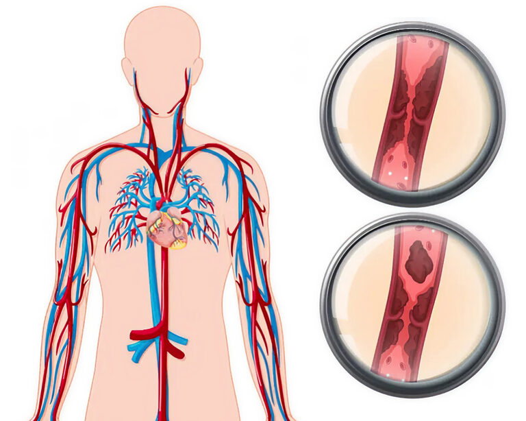 Инновации в лечении тромбозов