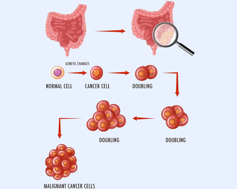 Скрытая кровь в кале: значение в онкологической диагностике, современные методы и перспективы