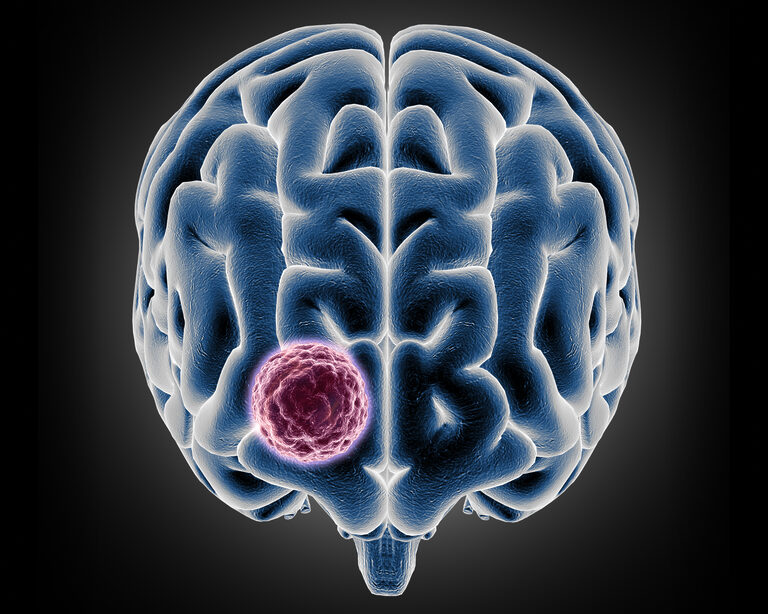 Аптамеры против агрессивной глиобластомы